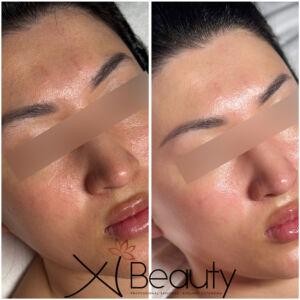 SIGNATURE TREATMENT
