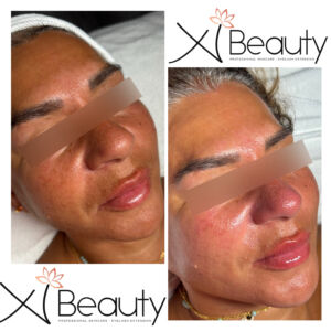 Facial