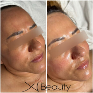 DERMAPLANING TREATMENT