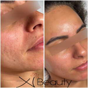 PROCELL-TREATMENT