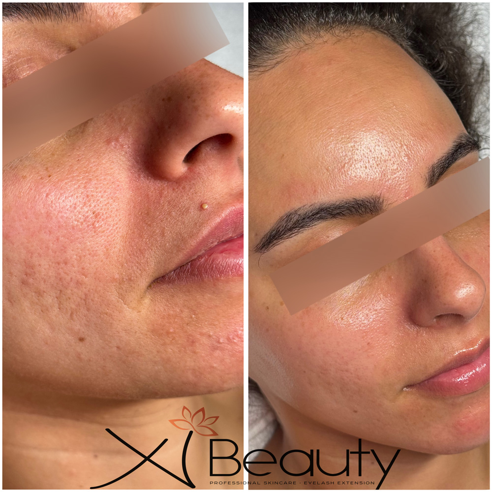 PROCELL-TREATMENT