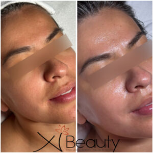 SENSITIVE-TREATMENT FACIAL